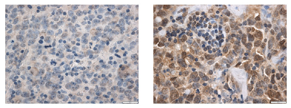 Farvning af PRDM11 (brun farve) i tumorer fra patienter med diffust storcellet B-lymfom. Nogle patienter mangler PRDM11 i kræftcellerne (venstre) og har en kortere overlevelse, sandsynligvis fordi manglen på PRDM11 gør deres kræftform mere aggressiv. Foto: Elisabeth Ralfkiær.