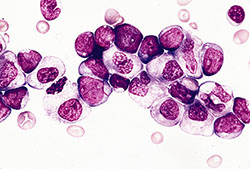 Wright-Giemsa farvning af en knoglemarv fra en patient med akut myeloid leukæmi. Rettigheder: Pathologyoutlines.com