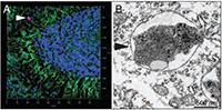 Figure. -synuclein, a PD dementia-causing protein aggregate, accumulates in nerve cells when the Ifnb gene is lacking. A. Light microscopy image of a Lewy body (red) inside the brain of an Ifnb-deficient mouse. B. A similar protein aggregate, shown by electron microscopy (arrowhead). Based on Ejlerskov et al. Cell 2015.