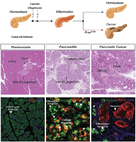 We have established a colony of pancreatic cancer mouse model (KC and KPC) that phenocopies many of the clinical manifestations of human PDAC. Tumors present with a prominent fibrous inflammatory reaction and spontaneously progress into metastatic PDAC. To study cancer initiation, we use the K-Ras G12D alleles (KC), which develops precursor lesions that evolve into invasive carcinoma after a long latency period. To study the interaction of tissue injury and cancer initiation we trigger pancreatic damage and tissue inflammation by the supraphysiological administration of caerulein (cholecystokinin analogue) in mice. It generates an acute pancreatitis that resolves within two weeks. However, the presence of an activating mutation in K-Ras prevents the resolution of tissue injury and results in the emergence of pancreatic intraductal neoplasia (PanINs) considered the precursor lesions of PDAC