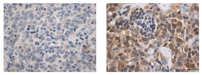 Staining of PRDM11 (brown color) in tumors from patients with diffuse large B-lymphoma. 