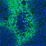 Microscope image of a breast cancer tumour showing hypoxic cells in green and DNA in blue. It is the hypoxic cells that produce lysyl oxidase.
