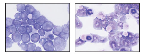 Leukemic cells