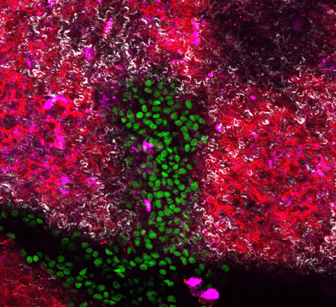Cancer cells (green) invade a lung scaffold (white - fibrillar collagen, red - collagen IV) populated with fibroblasts (magenta) inside of the model system.